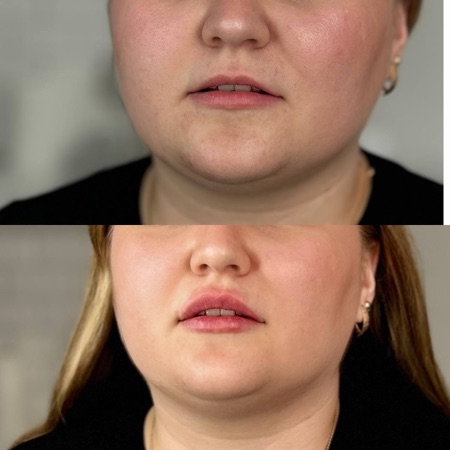 Работа Алины Гончаровой — коррекция формы губ