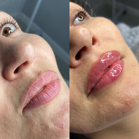 Работа Алины Гончаровой — увеличение объёма губ