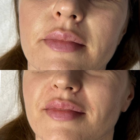 Работа Алины Гончаровой — коррекция губ