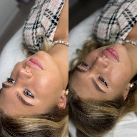 Работа Алины Гончаровой — коррекция губ