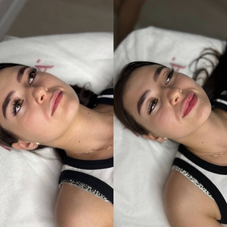 Работа Алины Гончаровой — увеличение губ