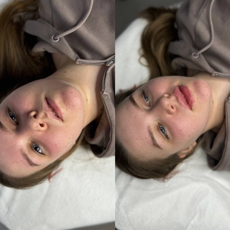 Работа Алины Гончаровой — коррекция губ