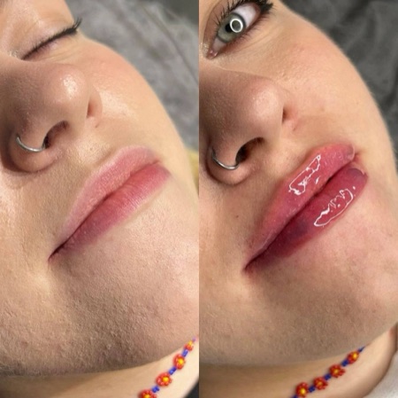 Работа Алины Гончаровой — увеличение губ